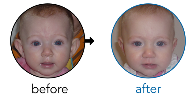 Before-and-after EarBuddies Stick-Out Ears result; started at 3–6 months – Julie and her Daughter