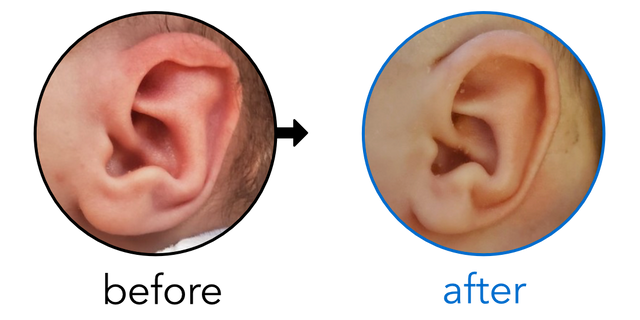 Before-and-after EarBuddies Stahl's Bar result; started at 1–3 months – Kylee & her Son