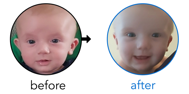Before-and-after EarBuddies Stick-Out Ears result; started at 1–3 months – Julia & her Son Ralph