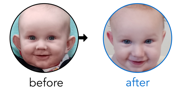 Before-and-after EarBuddies Stick-Out Ears result; started at 3–6 months – Christina & her son Matthew