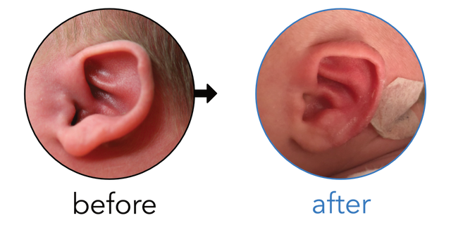 Before-and-after EarBuddies Stick-Out Ears result; started within the first month – Katherine & her Daughter Penelope