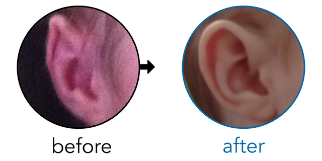 Before-and-after EarBuddies Folded-Over Helical Rim result; started within the first month – Laura & her Son Beck