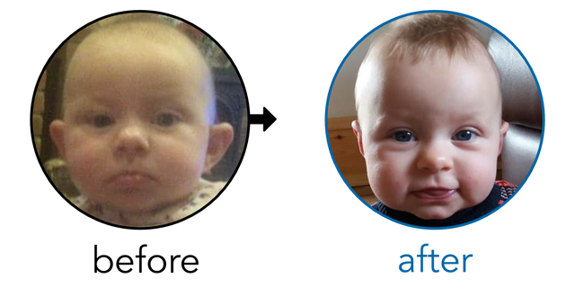 Before-and-after EarBuddies Stick-Out Ears result; started at 3–6 months – Melissa & Baby Emilia
