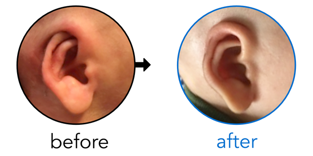 Before-and-after EarBuddies Cryptotia result; started within the first month – Gabriela & her Son Sebastián