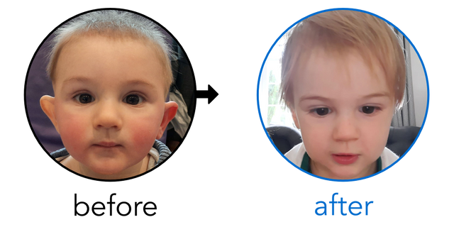 Before-and-after EarBuddies Stick-Out Ears result; started at 6–12 months – Danielle & her Son Jack