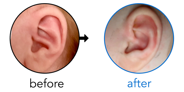 Before-and-after EarBuddies Conchal Crus result; started at 1–3 months – Carrie & her daughter Joanna
