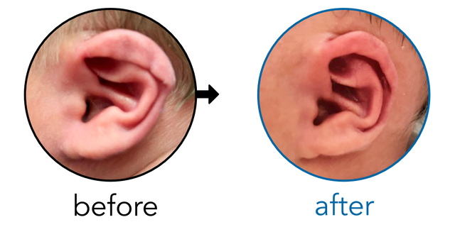 Before-and-after EarBuddies Rim Kink result; started within the first month – Matt, Jess, & their son Zeph