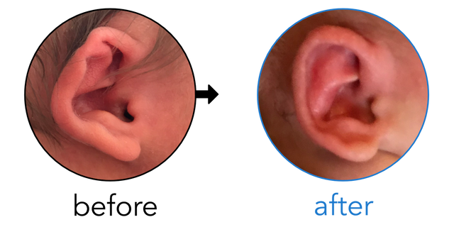 Before-and-after EarBuddies Stahl's Bar result; started within the first month – Jessica, Blaine & their Son Connor