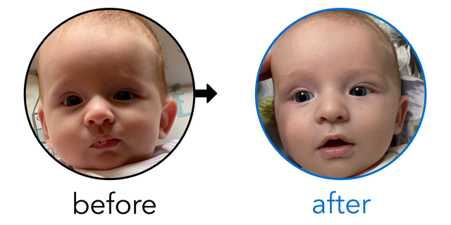 Before-and-after EarBuddies Stick-Out Ears result; started at 1–3 months – Samantha & her Son Zachary