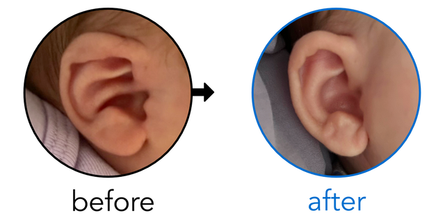 Before-and-after EarBuddies Conchal Crus result; started within the first month – Stephanie, Matt & their Daughter Molly