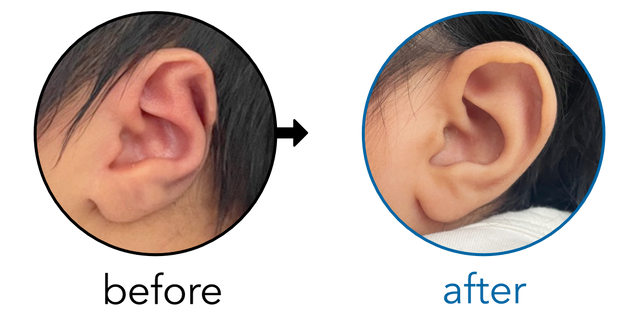 Before-and-after EarBuddies Stahl's Bar result; started at 3–6 months – Sofia & her daughter Imaan