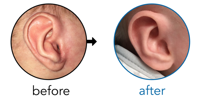 Before-and-after EarBuddies Conchal Crus result; started within the first month – Olivia & her Baby