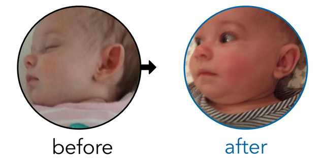 Before-and-after EarBuddies Stick-Out Ears result; started at 1–3 months – Niki & her Daughter Emilia