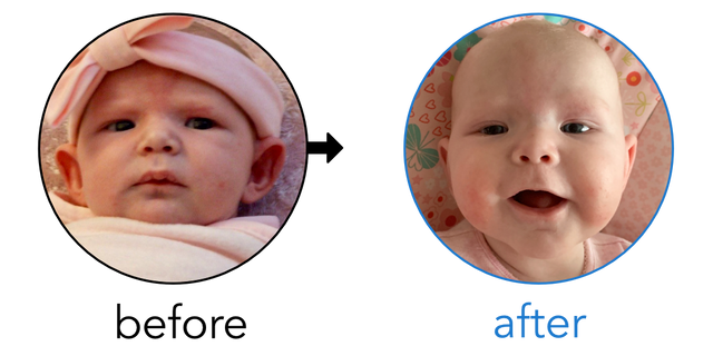 Before-and-after EarBuddies Stick-Out Ears result; started at 1–3 months – Kelly & her Daughter Blaire