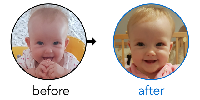 Before-and-after EarBuddies Stick-Out Ears result; started at 6–12 months – Ana, Milan & their Daughter Andrea