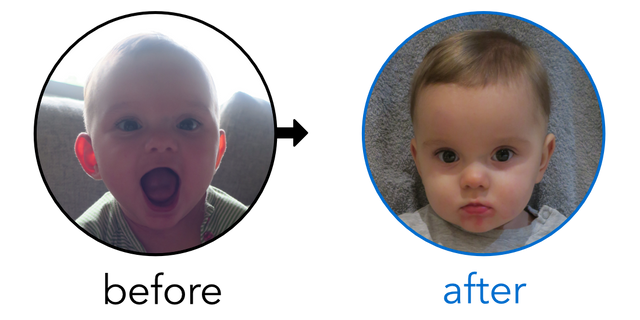 Before-and-after EarBuddies Stick-Out Ears result; started at 3–6 months – Alyssa & her Daughter