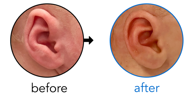 Before-and-after EarBuddies Folded-Over Helical Rim result; started within the first month – Alexandra & her son