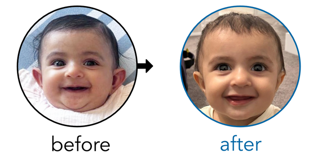 Before-and-after EarBuddies Stick-Out Ears result; started at 3–6 months – Tajanpreet & her Daughter