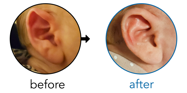 Before-and-after EarBuddies Folded-Over Helical Rim result; started at 1–3 months – Meira & her daughter