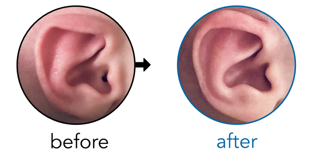 Before-and-after EarBuddies Lop Ear result; started within the first month – Chris, Melody & their baby Son
