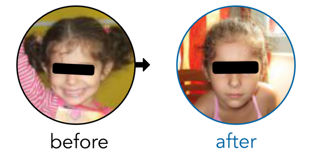 Before-and-after EarBuddies Stick-Out Ears result; started at 18+ months – Mrs T & her Daughter