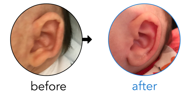 Before-and-after EarBuddies Stick-Out Lobe result; started at 1–3 months – Amy & her Daughter Celina