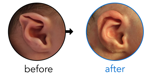 Before-and-after EarBuddies Stahl's Bar result; started within the first month – Liza, Oli & their Daughter Yvette