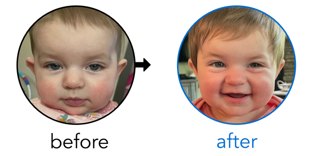 Before-and-after EarBuddies Stick-Out Ears result; started at 3–6 months – Jasmine & her daughter