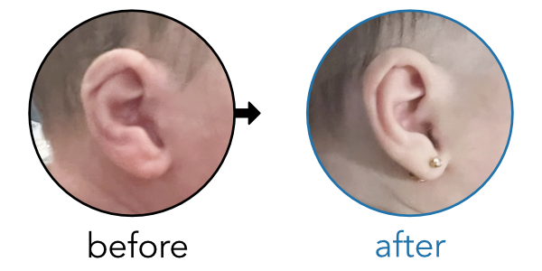 Before-and-after EarBuddies Lop Ear result; started within the first month – Shoshana & her daughter Ilona
