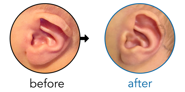 Before-and-after EarBuddies Lop Ear result; started within the first month – Elwyn & his son Emrys