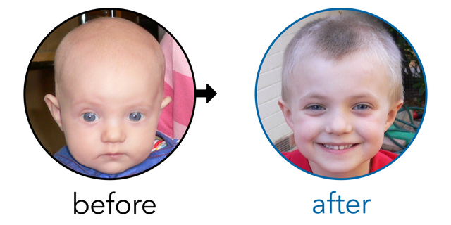 Before-and-after EarBuddies Stick-Out Ears result; started at 1–3 months – Kay R. & her Son Jason