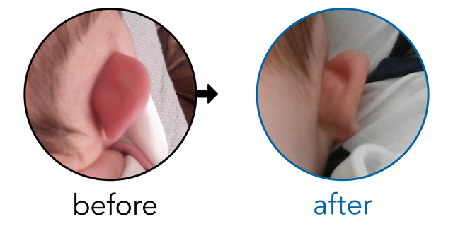 Before-and-after EarBuddies Stick-Out Ears result; started within the first month – Mr. H & his Daughter Scarlett