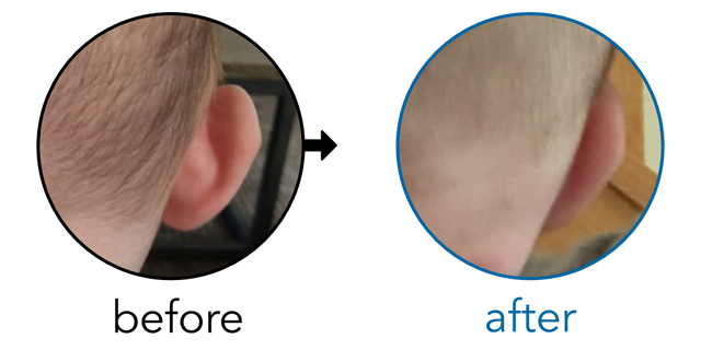 Before-and-after EarBuddies Stick-Out Ears result; started at 1–3 months – Simone M & her Baby Daughter