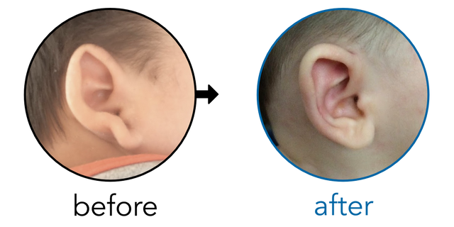Before-and-after EarBuddies Stick-Out Lobe result; started at 1–3 months – Anna & her Son Connor