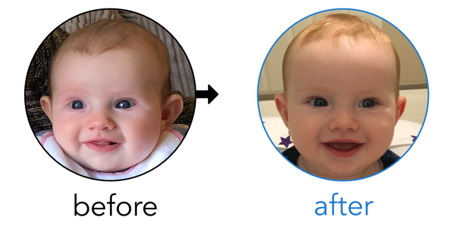 Before-and-after EarBuddies Stick-Out Ears result; started at 3–6 months – Emma, Peter & their Daughter Sophie