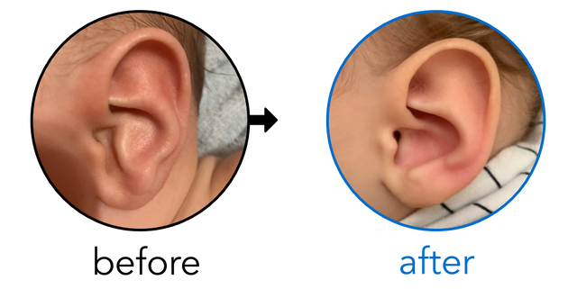 Before-and-after EarBuddies Conchal Crus result; started at 3–6 months – Brianna, Jake & their Son Bronny