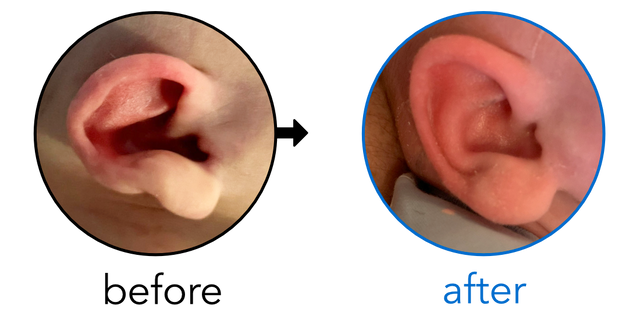 Before-and-after EarBuddies Stick-Out Ears result; started within the first month – Chloe & her daughter Holly