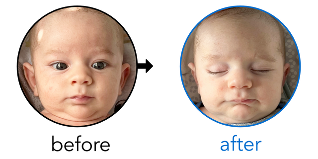 Before-and-after EarBuddies Stick-Out Ears result; started within the first month – Stephanie & her son Ezra