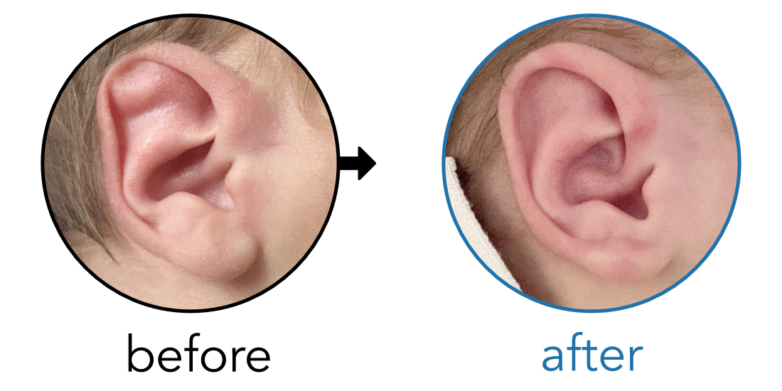 Before-and-after EarBuddies Stahl's Bar result; started within the first month – Gary & his son