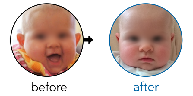 Before-and-after EarBuddies Stick-Out Ears result; started at 3–6 months – Mrs J & her Daughter