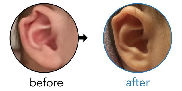 Before-and-after EarBuddies Rim Kink result; started at 3–6 months – Mrs. M & her Daughter