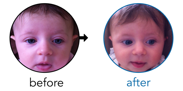 Before-and-after EarBuddies Stick-Out Ears result; started at 1–3 months – Genna & her Daughter