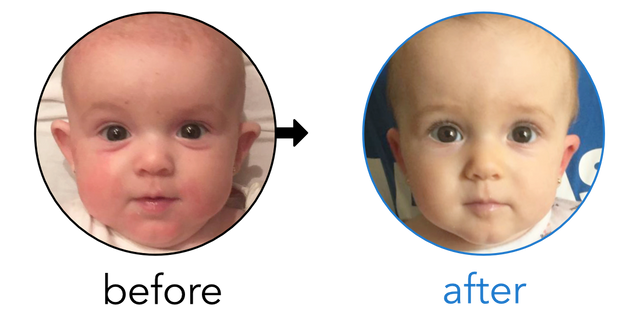 Before-and-after EarBuddies Stick-Out Ears result; started at 3–6 months – Lola, Stelios & their Daughter Alejandra