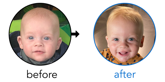 Before-and-after EarBuddies Stick-Out Ears result; started at 3–6 months – Lisa, Ben & their Son Remy