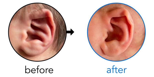 Before-and-after EarBuddies Conchal Crus result; started within the first month – Rebecca & her Son