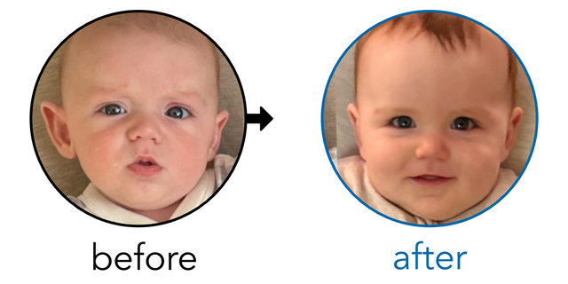 Before-and-after EarBuddies Stick-Out Ears result; started at 3–6 months – Anna & her son Tommy