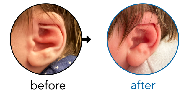 Before-and-after EarBuddies Conchal Crus result; started within the first month – Kerry & her son