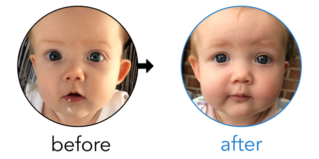 Before-and-after EarBuddies Stick-Out Ears result; started at 3–6 months – Helen & her Daughter Hannah