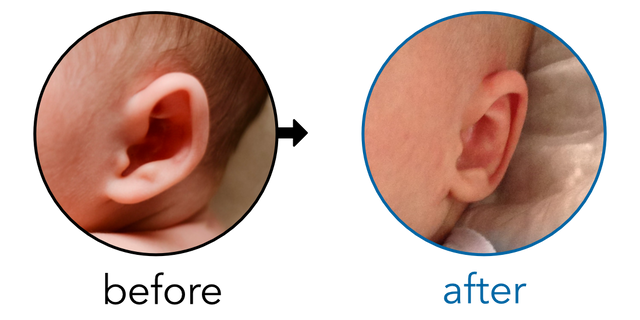 Before-and-after EarBuddies Stick-Out Ears result; started within the first month – Hayley & her Son Reggie