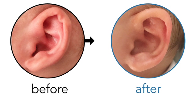 Before-and-after EarBuddies Rim Kink result; started at 1–3 months – Amelia & her Son Carter